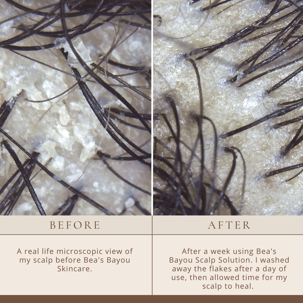 YeastDefense™️ Seborrheic Scalp Solution | Herbal Leave-in