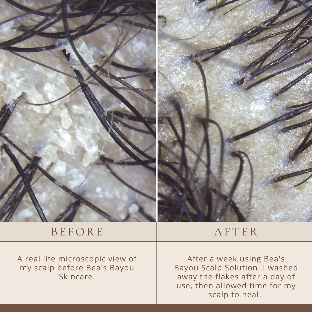 YeastDefense™️ Seborrheic Scalp Solution | Herbal Leave-in